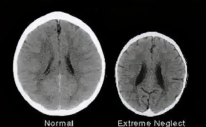 Kết quả nghiên cứu cho thấy trẻ hay bị phụ huynh la mắng (bên phải) có não bộ nhỏ hơn rất nhiều so với các bạn đồng trang lứa