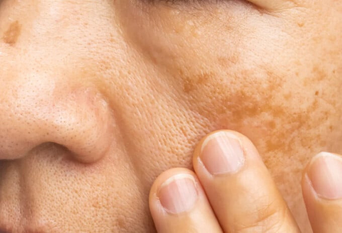 Da mặt sạm nám, thiếu sức sống có thể là một trong những dấu hiệu cảnh báo tiềm ẩn của bệnh thận (Ảnh: Internet)