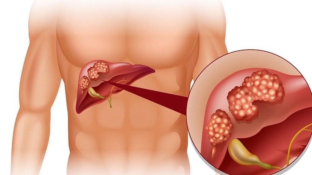 Bác sĩ Bệnh viện Bạch Mai cảnh báo 4 nhóm đối tượng có nguy cơ cao mắc ung thư tụy - ảnh 1