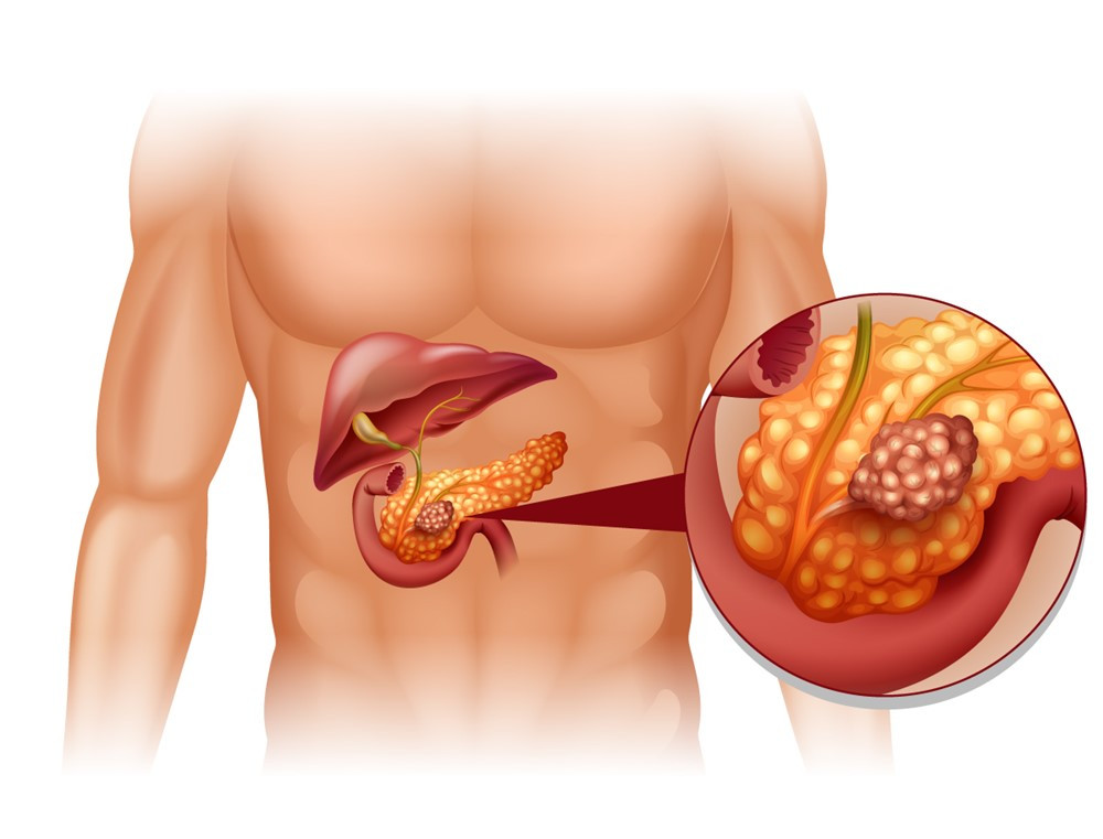 Cô gái 25 tuổi phát hiện ung thư sau cơn đau bụng và tử vong sau 1 tháng do bỏ qua các dấu hiệu bệnh - ảnh 3