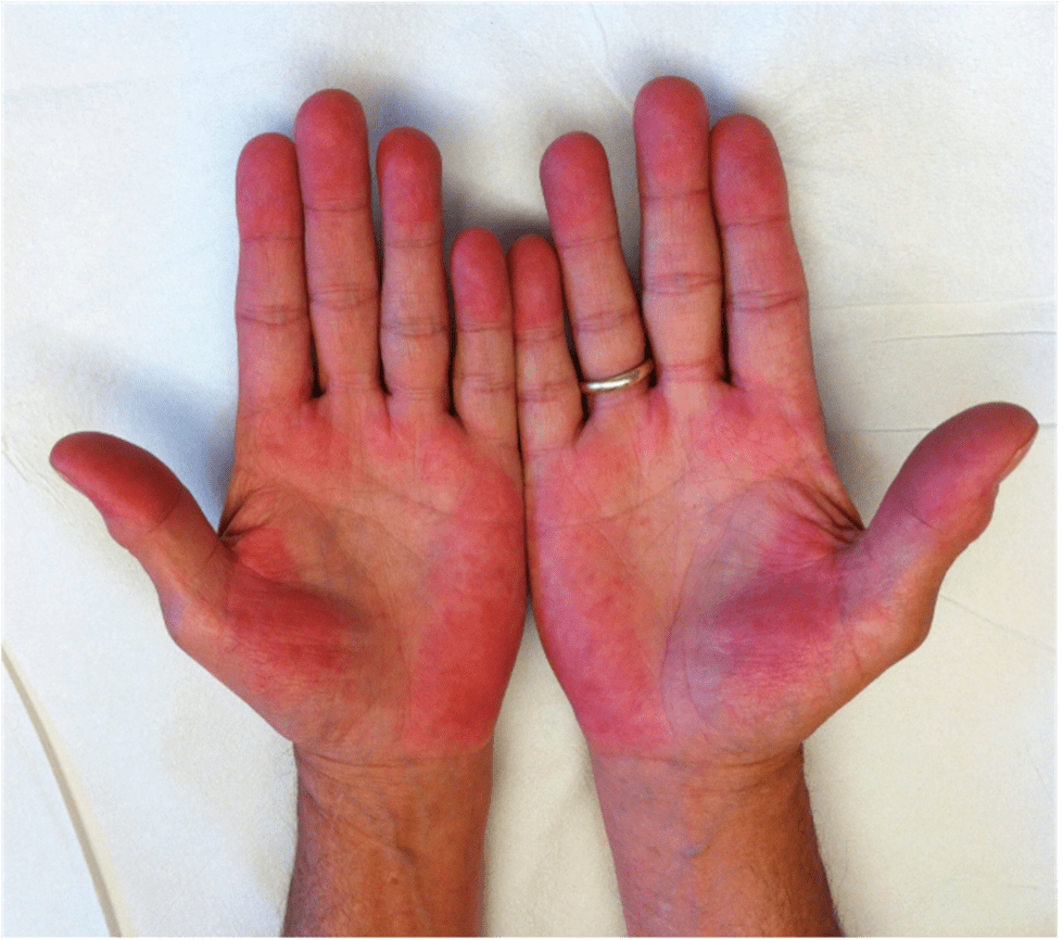 palmar-erythema-1-17313354734631241974901-1731374506943-17313745073852126214980_11zon.png