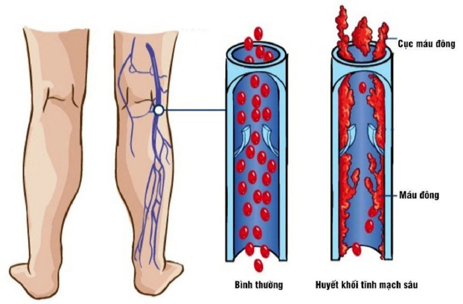 Dấu hiệu bất thường ở chân cảnh báo ung thư tuyến tụy - ảnh 2