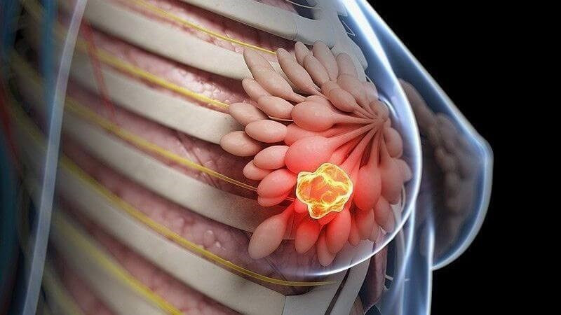 Ung thư vú: Dấu hiệu, nguyên nhân và cách điều trị