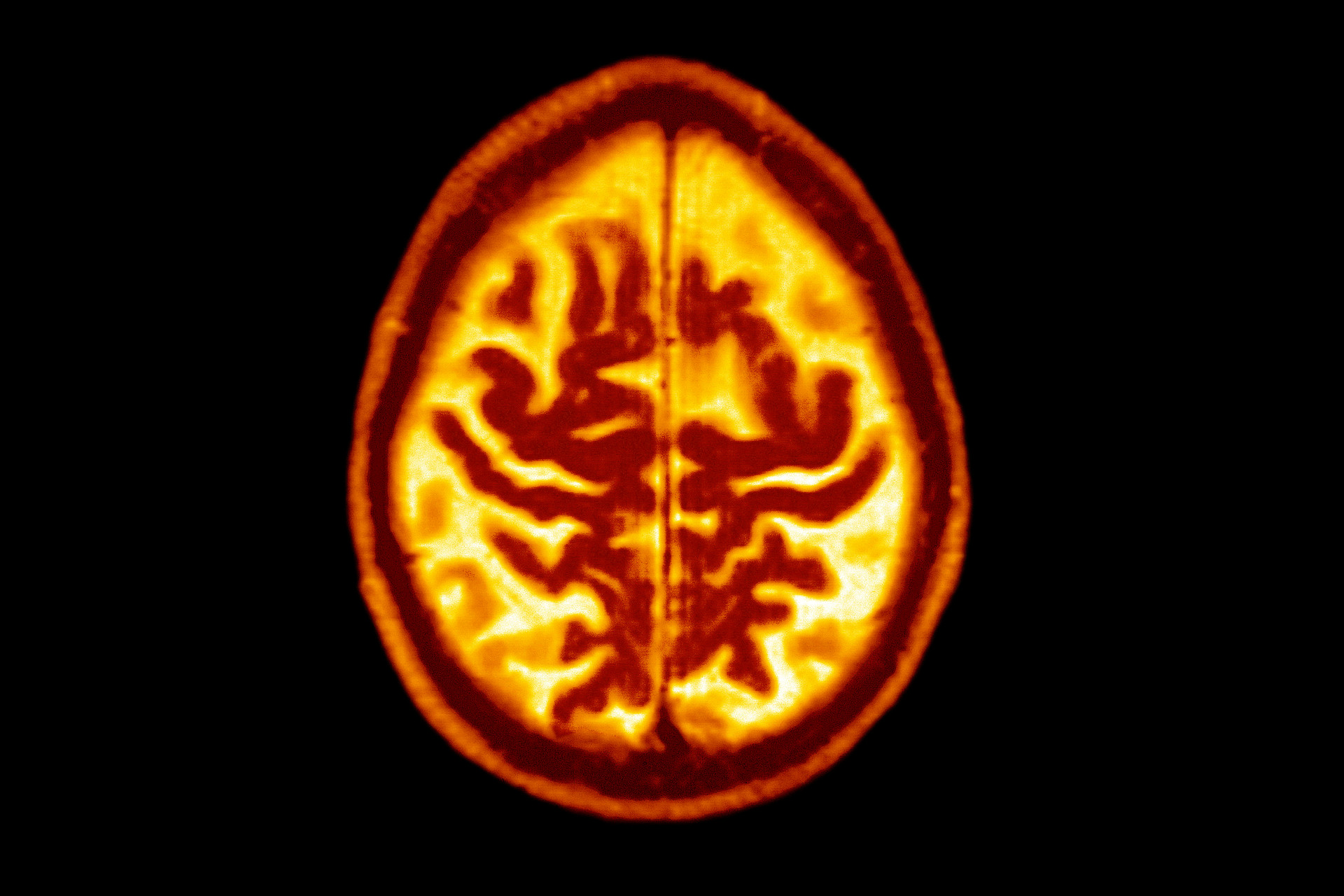 Hình ảnh cắt ngang của não bị ảnh hưởng bởi bệnh Alzheimer khởi phát muộn, cho thấy sự mở rộng đối xứng của các rãnh não