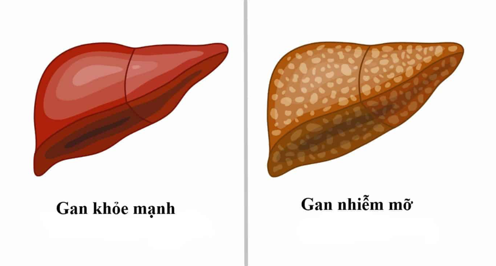 Chuyên gia phát hiện 'bom hẹn giờ' dẫn tới ung thư gan - ảnh 2