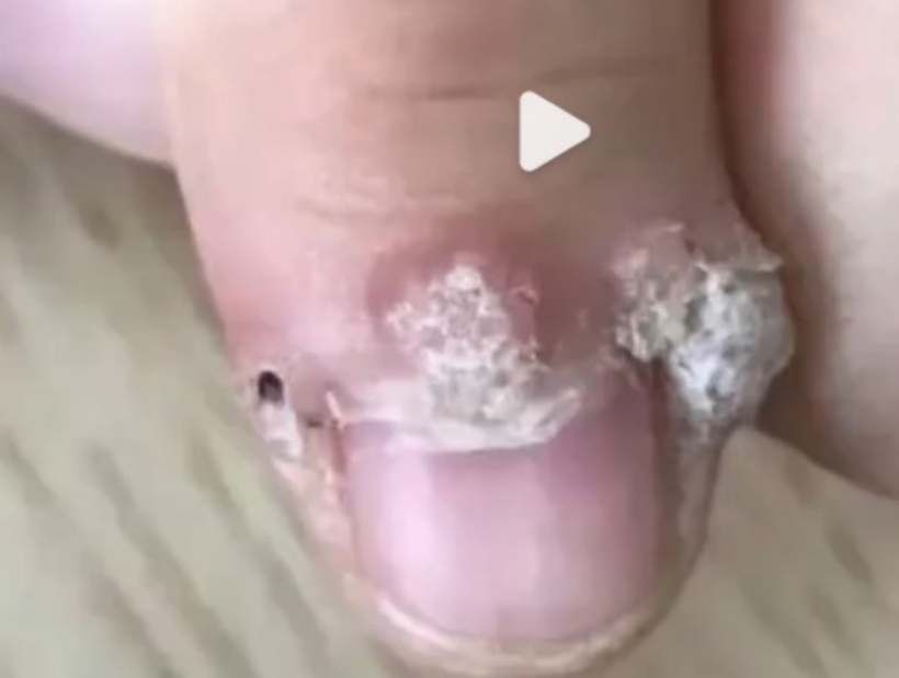 Nhiễm virus HPV khi đi làm nail đón Tết, cô gái 22 tuổi phải nhập viện cấp cứu - ảnh 1