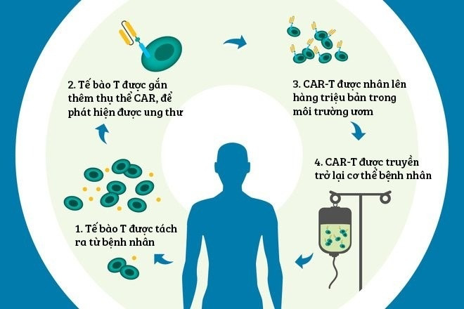 Phương pháp CAR-T là gì? Tại Việt Nam, chi phí điều trị tại Vinmec chỉ bằng 1/10 so với ở Singapore