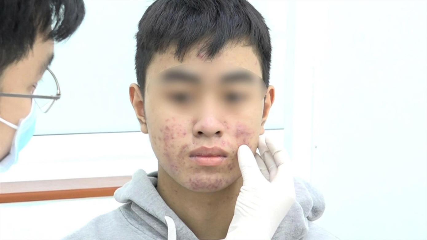 Bệnh nhân gặp tai biến da nghiêm trọng vì tin vào lời quảng cáo “trắng cấp tốc”. Ảnh: Bệnh viện cung cấp benh-nhan-tai-bien-da.jpg
