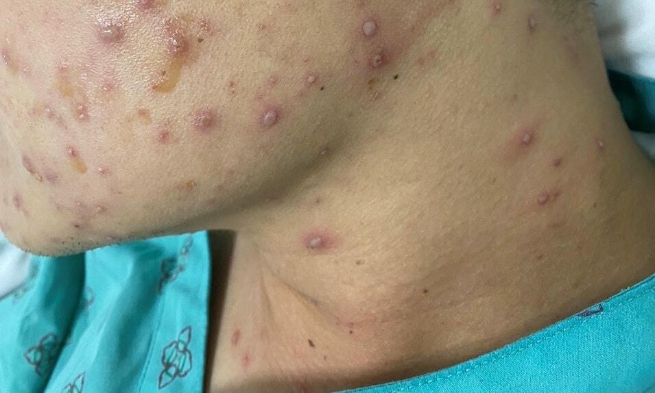 Căn bệnh lây nhanh đang bùng phát khi trời lạnh, hiện chưa có thuốc đặc trị - ảnh 1