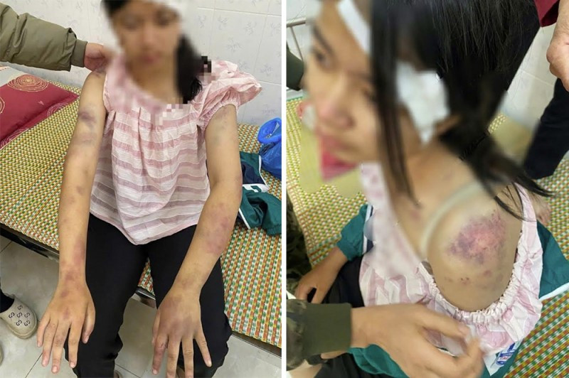 Công an khẩn trương xác minh vụ bé gái 13 tuổi bị ông bà nội tra tấn dã man, phải nhập viện - ảnh 1