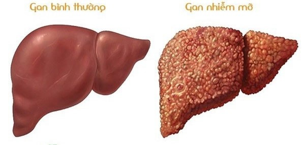 Vì sao người gầy vẫn có thể bị gan nhiễm mỡ? - ảnh 1
