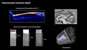 Công ty của Elon Musk cấy chip vào não người chỉ trong 1,5 giây, hơn 10.000 người đang xếp hàng - ảnh 1
