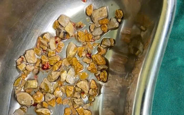 Mổ sỏi thận nhưng không tái khám, bà M. phải nhập viện do đau dữ dội, thận gần như hư hỏng hoàn toàn - ảnh 2