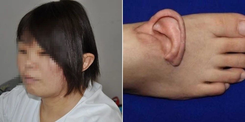 Chưa từng có trong lịch sử: Ca ghép tai người vào chân đầu tiên trên thế giới thành công, đánh dấu bước đột phá trong y học tái tạo - ảnh 1