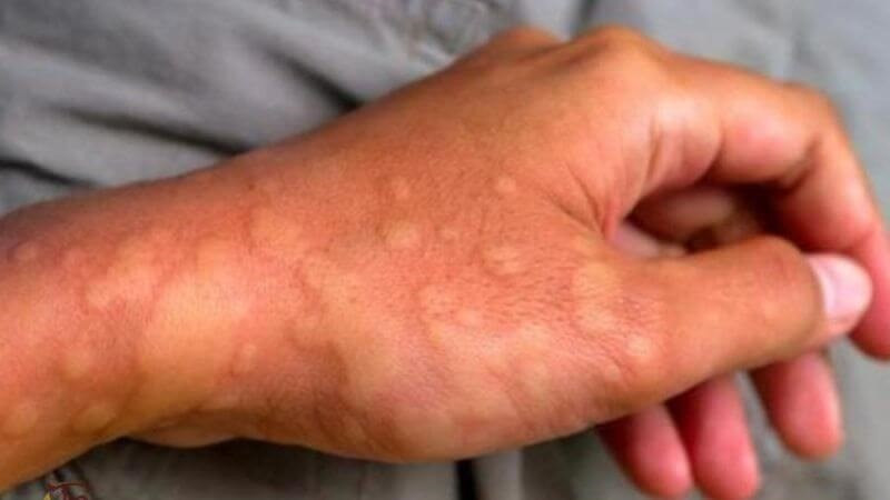 Gia tăng các bệnh da liễu trong mùa lạnh, hanh khô: Bác sĩ Bệnh viện 108 mách '3 không, 2 đủ' để bảo vệ làn da - ảnh 3