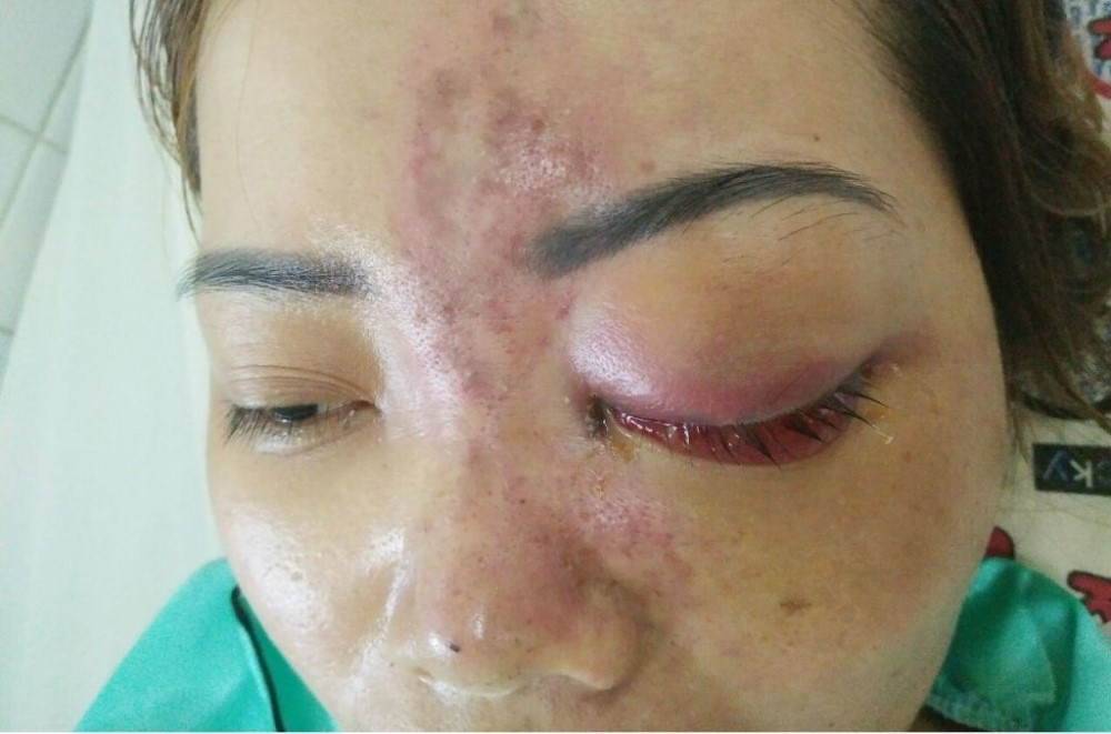 Biến chứng thẩm mỹ gần Tết tăng 20%, bác sĩ cảnh báo - ảnh 2