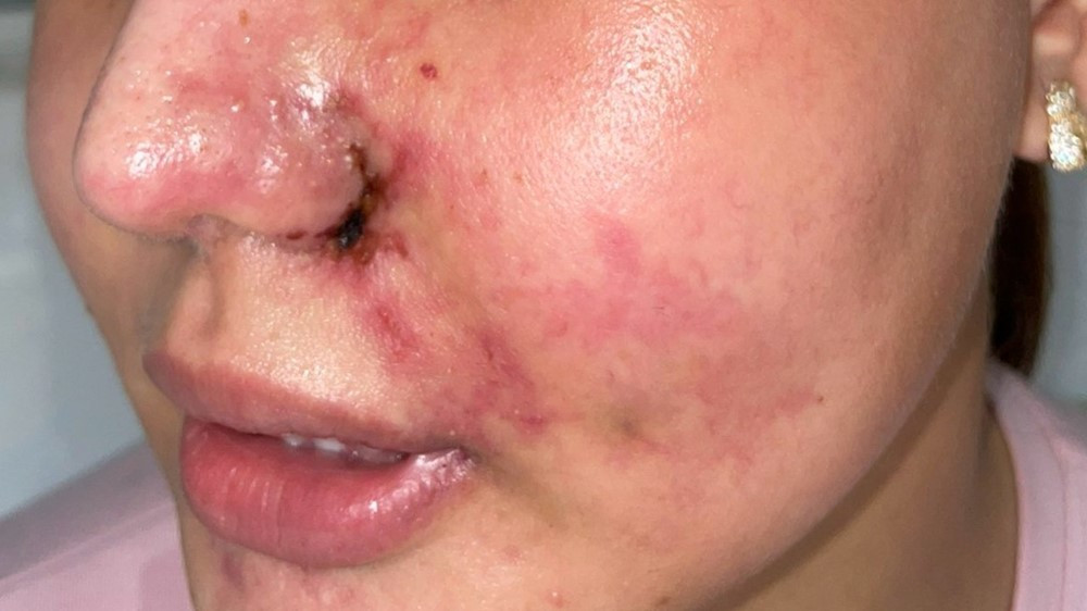 Biến chứng thẩm mỹ gần Tết tăng 20%, bác sĩ cảnh báo - ảnh 1