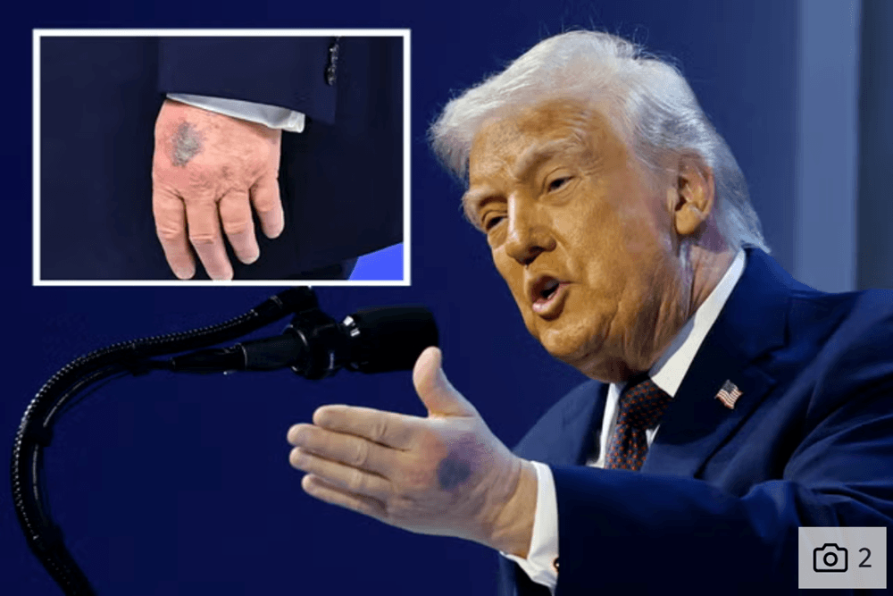 Lộ ảnh một bên tay bị bầm tím gây sốt cộng đồng mạng, ông Trump nói gì? - ảnh 1