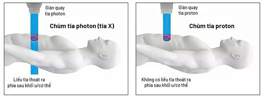 xa-tri-photon-tia-x-dua-lieu-xa-vao-khoi-u.jpg