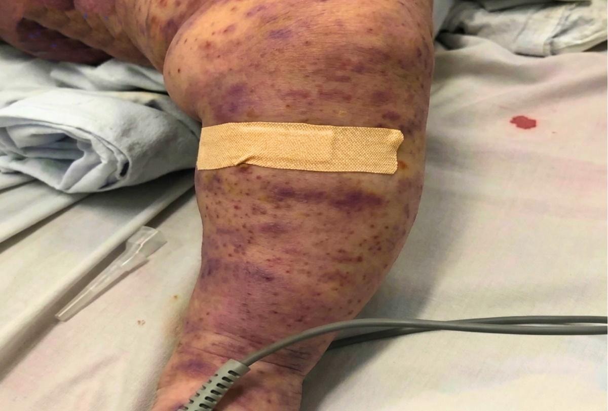 24 ca mắc, 4 ca tử vong, gây tử vong trong 24 giờ: Bác sĩ BV Bạch Mai phát cảnh báo 'nóng' về căn bệnh nguy hiểm