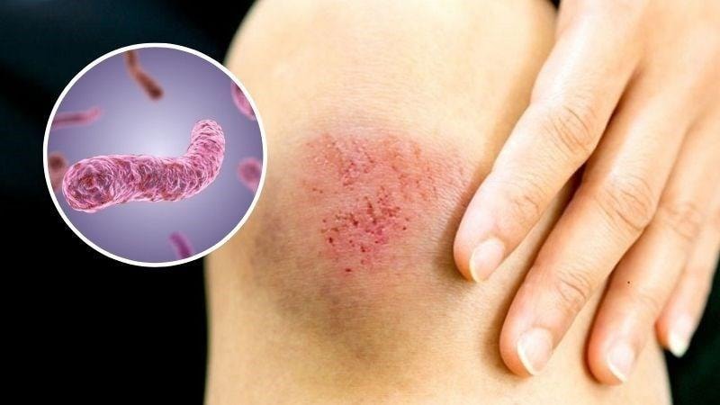 732 ca mắc, 23 ca tử vong: Láng giềng Việt Nam phát cảnh báo khẩn về bệnh 'sốt đất' nguy hiểm