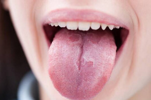 5 dấu hiệu ở lưỡi cảnh báo loạt bệnh ung thư, đột quỵ nguy hiểm đang đến gần: Đừng chủ quan!