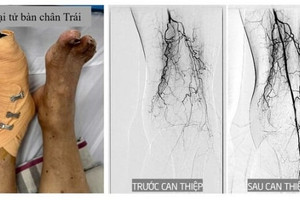 Bệnh nhân 80 tuổi bị hoại tử chân bay từ Mỹ về Việt Nam điều trị, thoát khỏi cơn nguy kịch