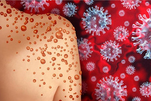 Nóng: WHO phát động chiến dịch toàn cầu khống chế chủng virus mới, dự kiến bắt đầu từ tháng sau