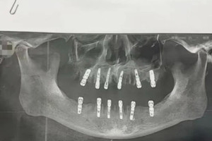 Tử vong vì nhổ và trồng gần 40 chiếc răng trong một ngày