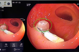 Những khả năng phi thường của A.I trong nội soi tiêu hóa