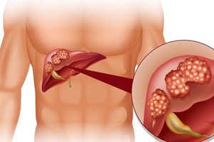 Bác sĩ Bệnh viện Bạch Mai cảnh báo 4 nhóm đối tượng có nguy cơ cao mắc ung thư tụy