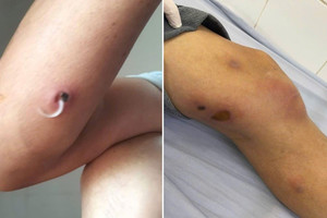 Phát hiện căn bệnh hiếm, chưa có vaccine phòng ngừa tại Việt Nam