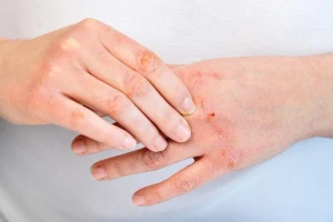Mưa bão, lụt lội: Cẩn trọng với nguy cơ bỏng và mắc các bệnh về da
