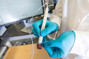 Bút phát hiện ung thư chỉ trong 10 giây chính thức được thử nghiệm lâm sàng tại bệnh viện