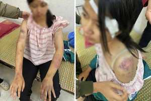 Công an khẩn trương xác minh vụ bé gái 13 tuổi bị ông bà nội tra tấn dã man, phải nhập viện
