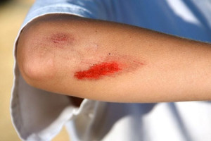 Chủ quan vì những vết xước nhỏ, nhiều người nhập viện trong tình trạng nguy kịch