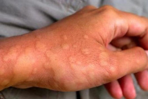 Gia tăng các bệnh da liễu trong mùa lạnh, hanh khô: Bác sĩ Bệnh viện 108 mách '3 không, 2 đủ' để bảo vệ làn da