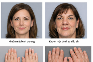 Bác sĩ bệnh viện Bạch Mai cảnh báo bệnh nguy hiểm: Tay chân to dần, đổi cỡ giày là những dấu hiệu đầu tiên