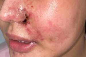 Biến chứng thẩm mỹ gần Tết tăng 20%, bác sĩ cảnh báo