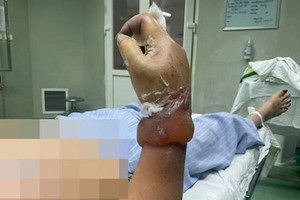 Dựng cây nêu ngày Tết, người phụ nữ có nguy cơ phải cắt cụt cẳng tay vì điện giật