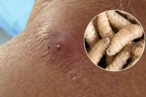 Mỹ ban bố tình trạng thảm họa, cảnh báo nguy cơ từ ký sinh trùng ăn thịt người