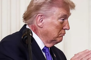 Vết đỏ lớn sau cổ ông Trump khiến dư luận xôn xao