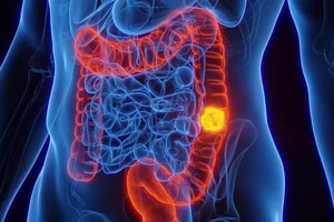 Nửa năm sụt 8kg, người phụ nữ bất ngờ phát hiện ung thư giai đoạn muộn