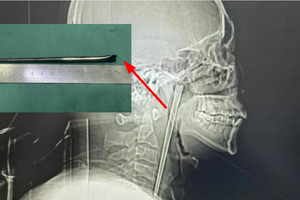 Phát hiện đũa kim loại dài 12cm mắc kẹt suốt 8 năm trong cổ họng của người đàn ông 46 tuổi
