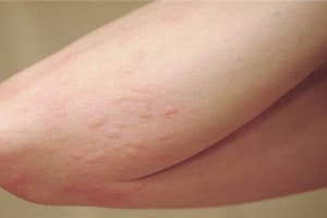 Tưởng chỉ ngứa da do thời tiết, người đàn ông đi khám phát hiện ung thư gan giai đoạn 3