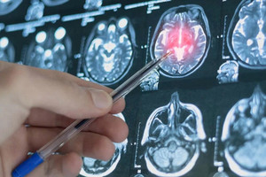 AI Trung Quốc phát hiện dấu hiệu trầm cảm trước 4 năm, hé lộ cách não bộ 'báo trước' nguy cơ