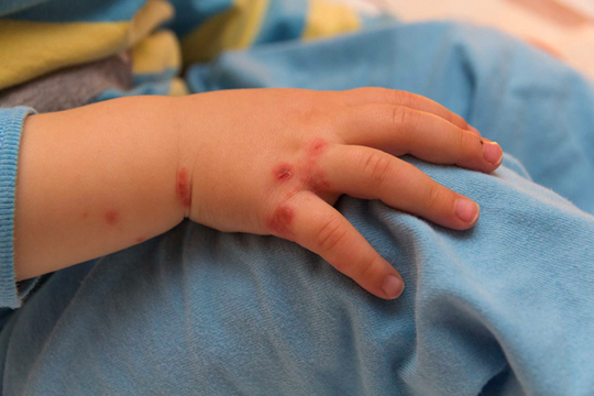 Những dấu hiệu nhận biết sớm bệnh tay, chân, miệng ở trẻ nhỏ