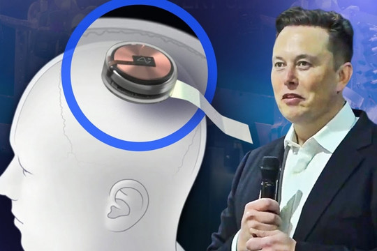 Neuralink của Elon Musk gặp sự cố sau ca cấy chip vào não người đầu tiên