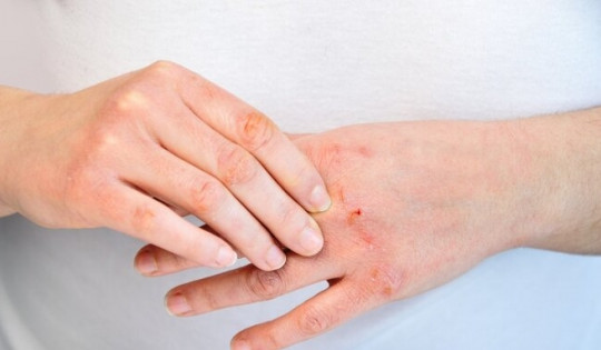 7 dấu hiệu bất thường ở tay chân có thể là 'lời cảnh báo' của cơ thể về ung thư