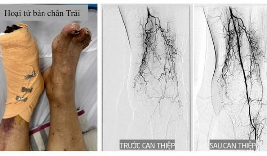 Bệnh nhân 80 tuổi bị hoại tử chân bay từ Mỹ về Việt Nam điều trị, thoát khỏi cơn nguy kịch